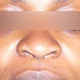 rhinoplastie de type "africain"
