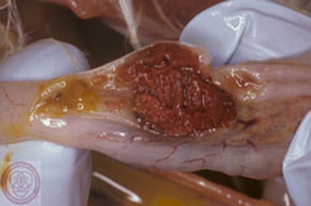 [التهاب+وتقرح+لوزة+الاعور.jpg]