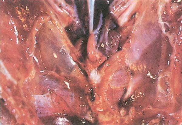 [ترسبات+فبرينيه+علي+الاحشاء+الداخليه.jpg]