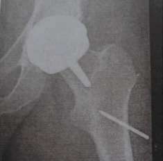 Alignment pin found at post op X-ray