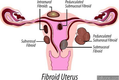 What Causes Fibroids In The Womb | Fibroids Treatment