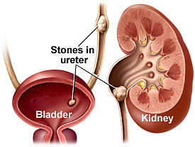 [kidney-stones[1].jpg]