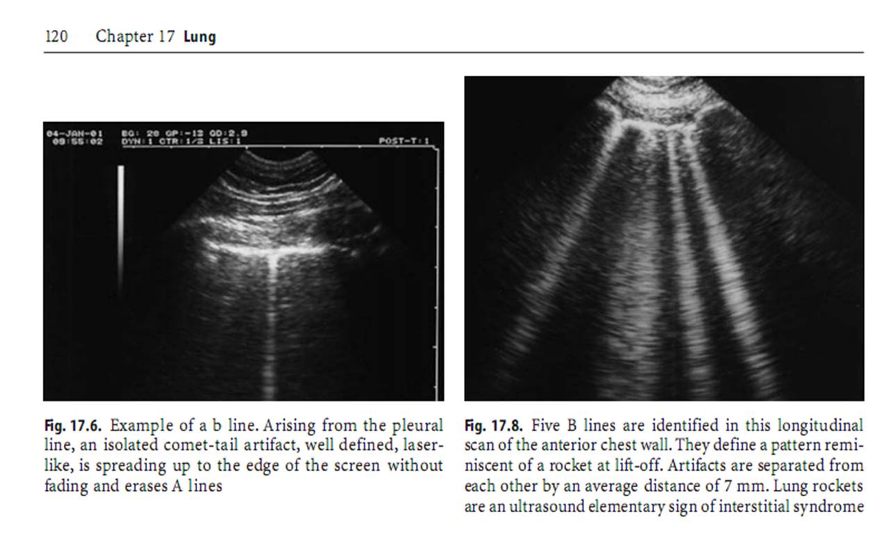 BÀI SOẠN VỀ SIÊU ÂM CHẨN ĐOÁN ALINES, BLINES and AIR ARTIFACTS