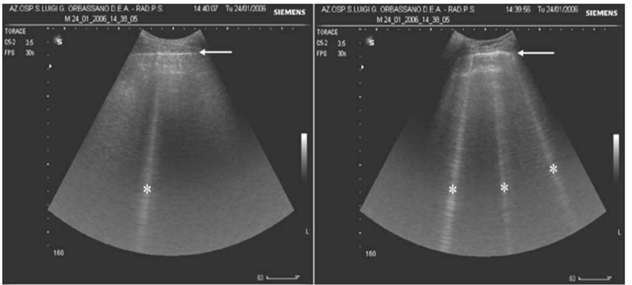 BÀI SOẠN VỀ SIÊU ÂM CHẨN ĐOÁN ALINES, BLINES and AIR ARTIFACTS