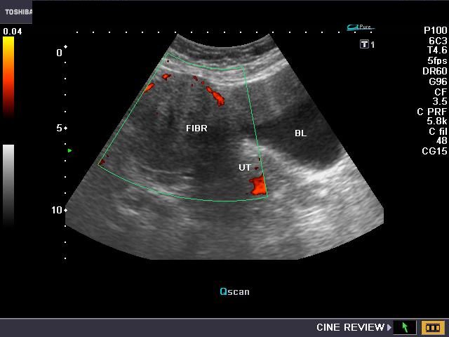  ... of ultrasound images of different types of fibroids on this page