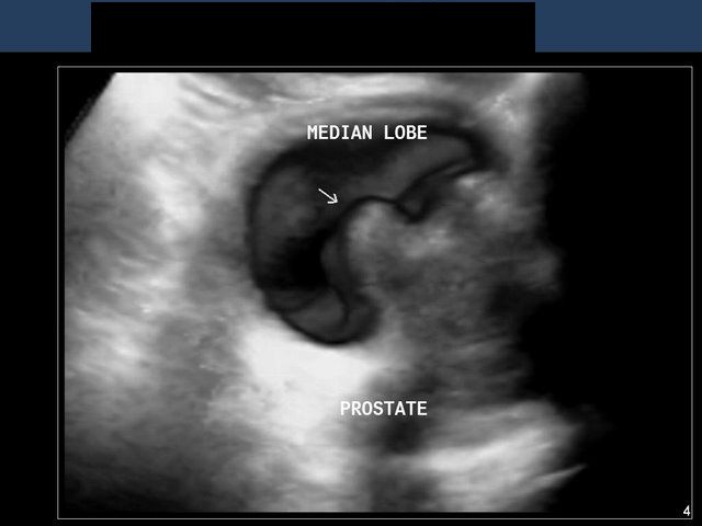 Baker Cyst Ultrasound