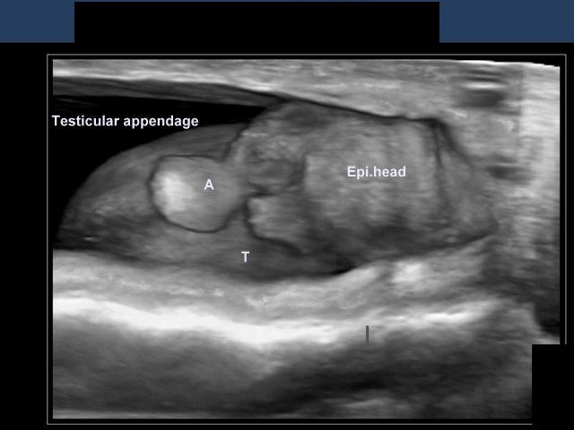 cochinblogs: 3-D ultrasound image of appendix of testis: