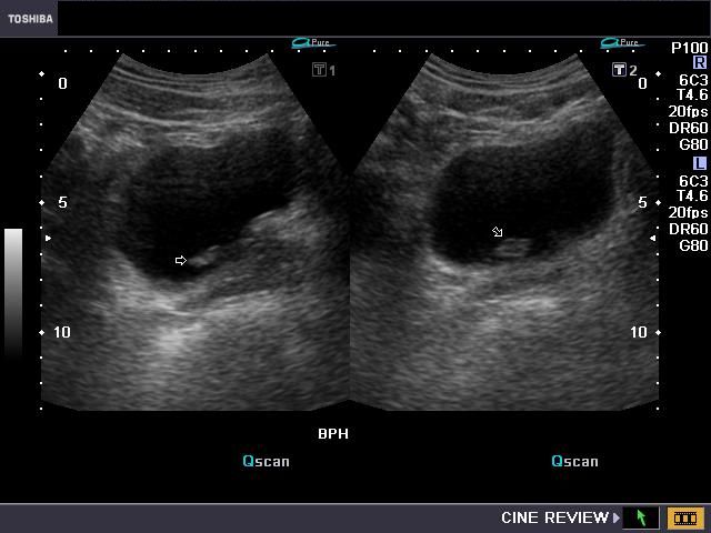 Polyp Ultrasound