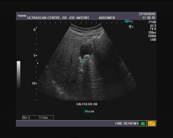 ultrasound for gallbladder