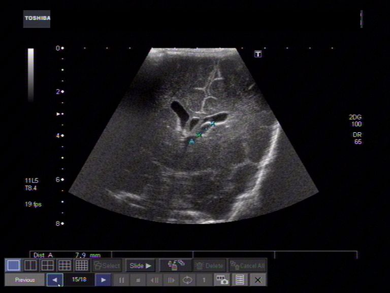 Tunica Albuginea Cyst