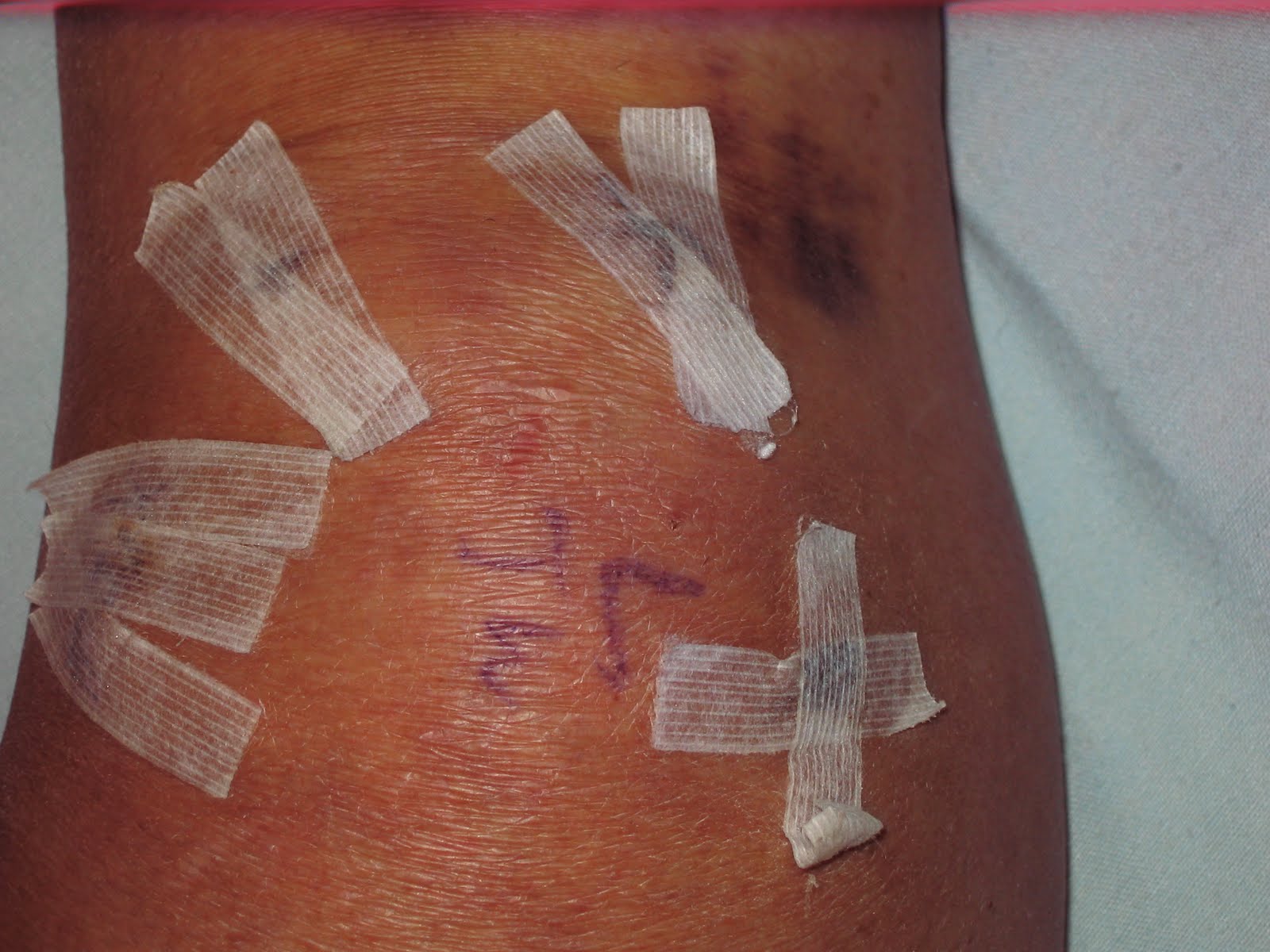 Sebaceous Cyst Removal Post Surgery