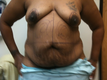 Tummy Tuck with Breast Augmentation