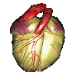 Heart Attack