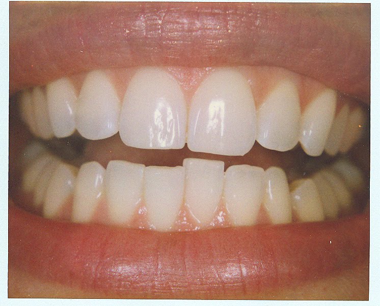 Bellevue Cosmetic Dentist Choosing the Best Dentistry COSMETIC TOOTH