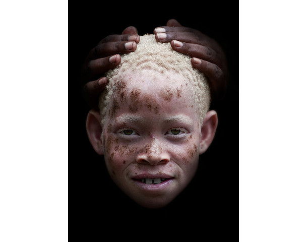 Albino Kenyan