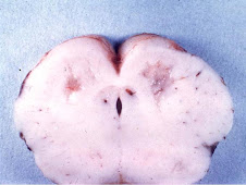 Necrosis licuefactiva (encefalomalacia)