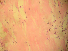 Amiloidoisis renal (médula)