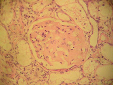 Amiloidosis renal (corteza)