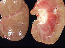 Amiloidosis en riñón