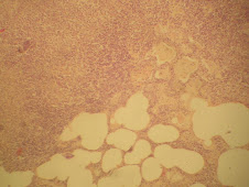 Neumonía granulomatosa (tbc)