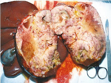 Carcinoma colangiocelular