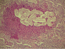 Granuloma parasitario pulmonar