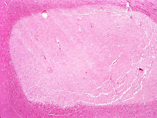 Encefalomalacia nigropalidal