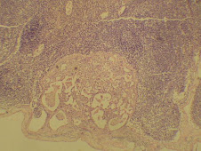 Metástasis de carcinoma en linfonódulo