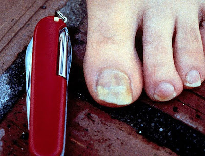 Toenail fungus is a serious disease that is contagious and may even be
