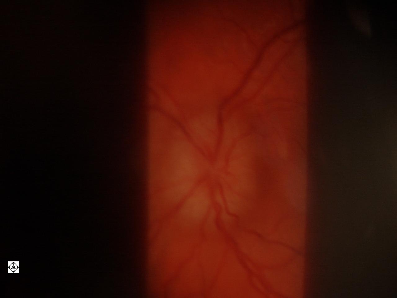 Papilledema Picture