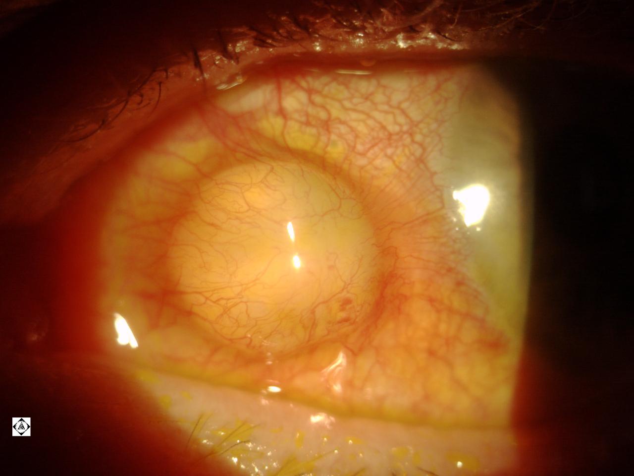 Iris Cyst: - Department of Ophthalmology.