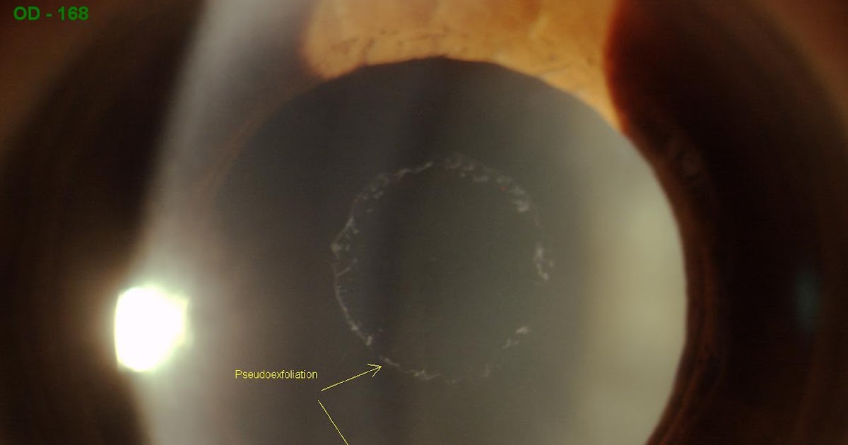 Sonoran Desert Eye Center PSEUDOEXFOLIATION
