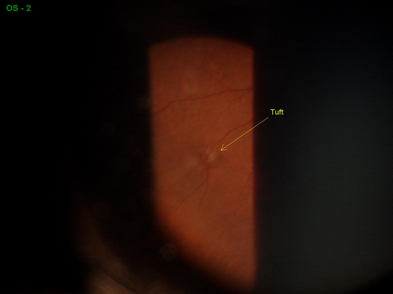 Sonoran Desert Eye Center VITREORETINAL TUFT