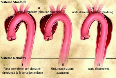aorta ascendente