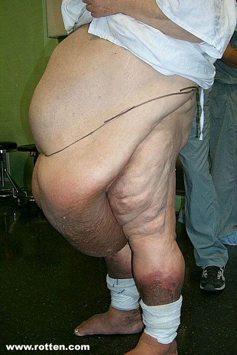 [obesidade+morbida.jpg]