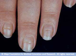 Clubbing occurs when the tips of your fingers enlarge and your nails