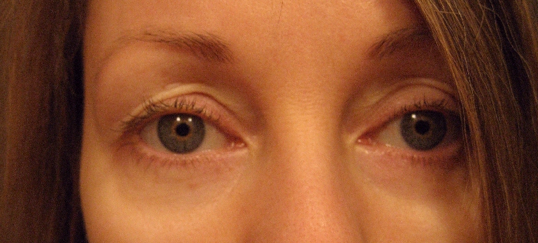 eyelids droopy eyes retin saggy skin hooded aging chemical acne peels peel peeling mychemicalpeel anti got started scaly using before