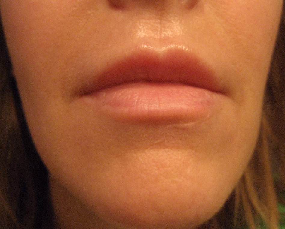Chemical Peels for Acne and Anti Aging Above Lip Vertical Lines the