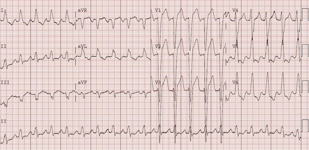 Left bundle branch block (LBBB) in acute myocardial infarction: the  Sgarbossa criteria – ECG & ECHO