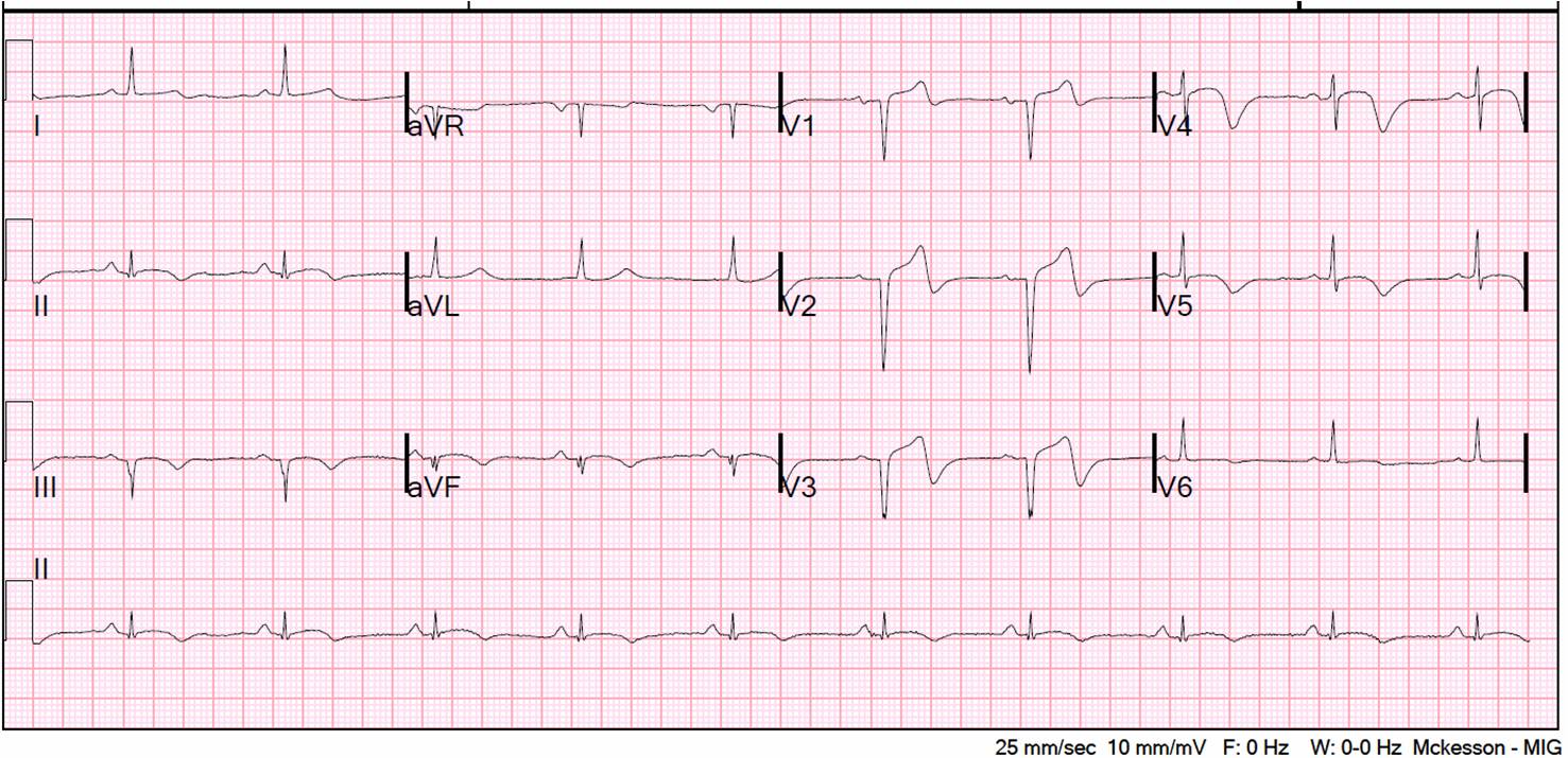 Stemi Ekg