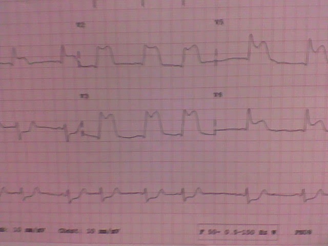 medication for pulseless electrical activity medication for pulseless electrical activity