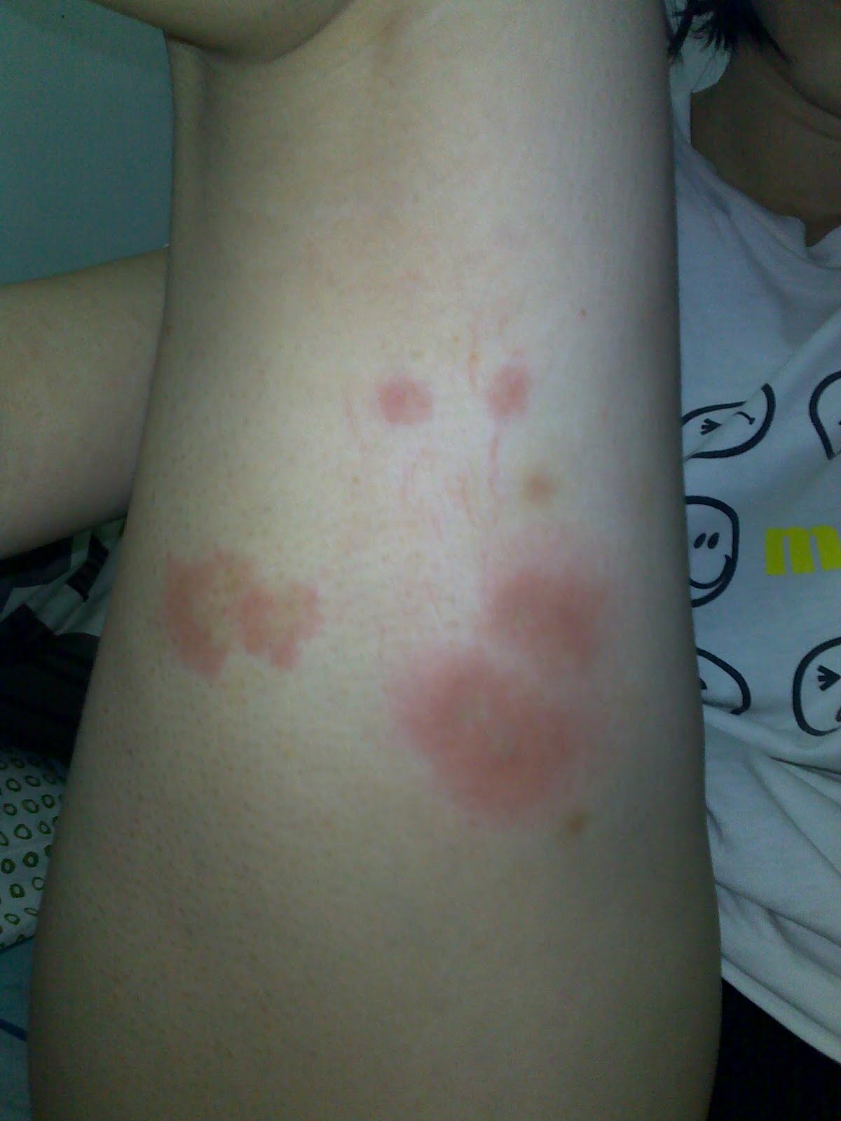 waking up with bites