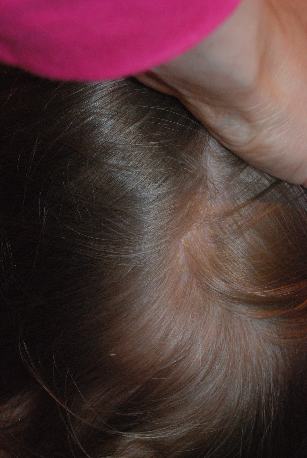 The Davidson Den How to Cure Cradle Cap