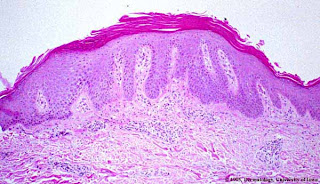 Las vitaminas del grupo en para el tratamiento de la psoriasis