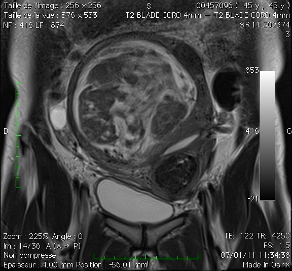 fibromes uterins Les fibromes utérins