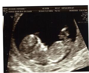1st Ultrasound at 11 weeks