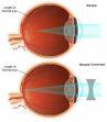 ABLASI RETINA