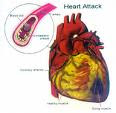 infark miokard akut