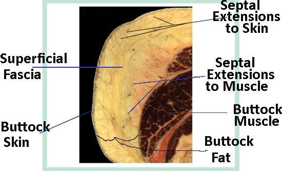 [cellulite-SFS5.jpg]