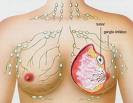 imagen del cáncer de mamas